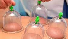 Cupping Therapy